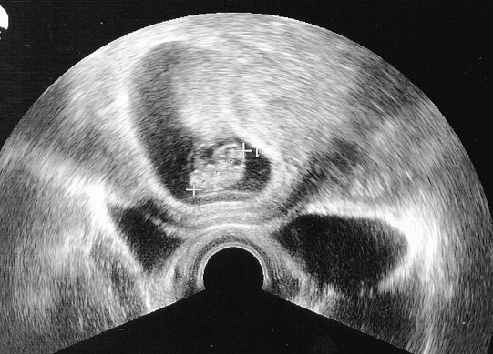 2cm de long 04 - 8SA